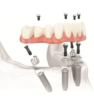 All on 4 dental implants