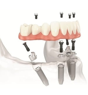 All on 4 dental implants