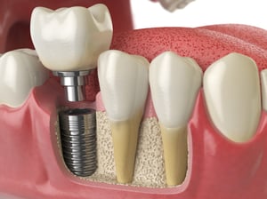 Dental-Implants-Market