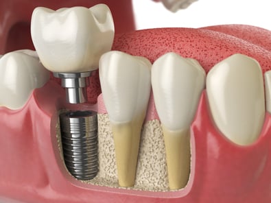 dental implants in jaw bone graft