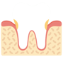 Gingivitis