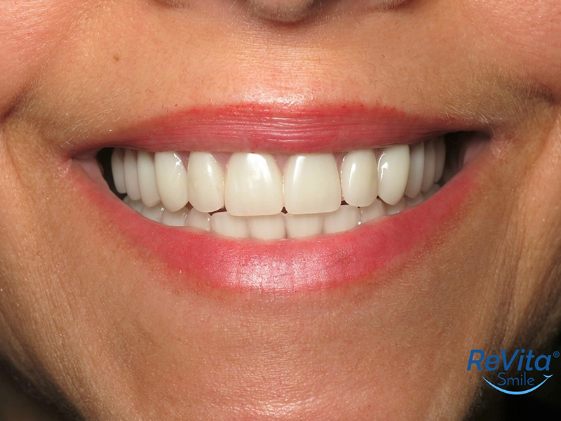Reconstructed Teeth All-on-4 Dental
