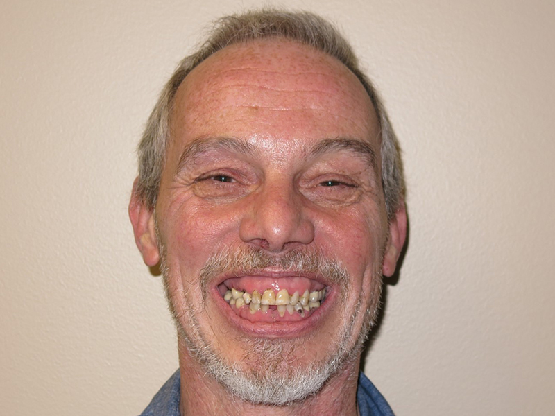 ReVita Smile - Full Arch Implant Before