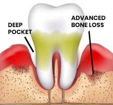 Periodontis