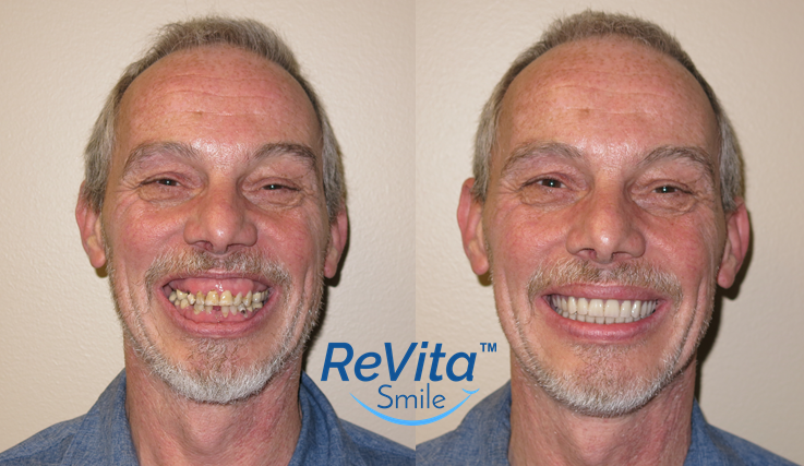 ReVita Smile Before-After_Vincent-2