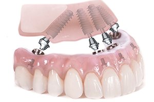 all on 4 dental implants