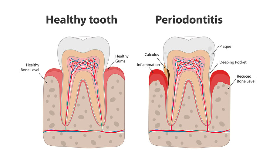 bigstock-Healthy-Tooth-And-Unhealthy-To-306806815