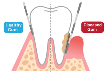 gum disease vs healthy gums periodontist