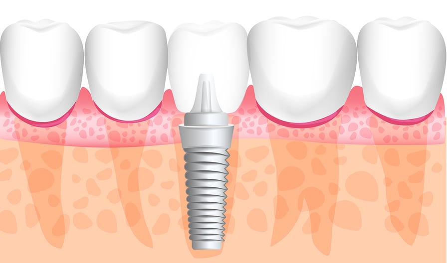 dental implant screwed into jaw bone graft in mouth teeth