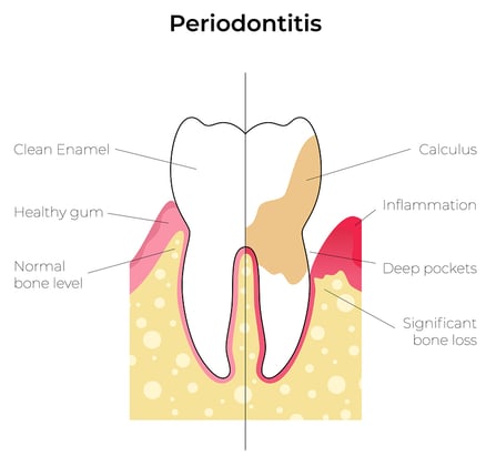periodontitis tooth example 