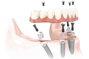 All-On-4 Dental implant