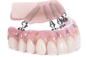 All-on-4 Avoid Bone Grafting