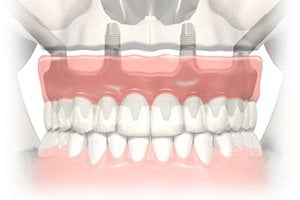 Full Arch Rehabilitation